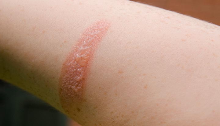 What to Do After a Minor Burn? Immediate First Aid & Care Steps
